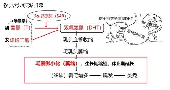 女性型雄激素性秃发脱发