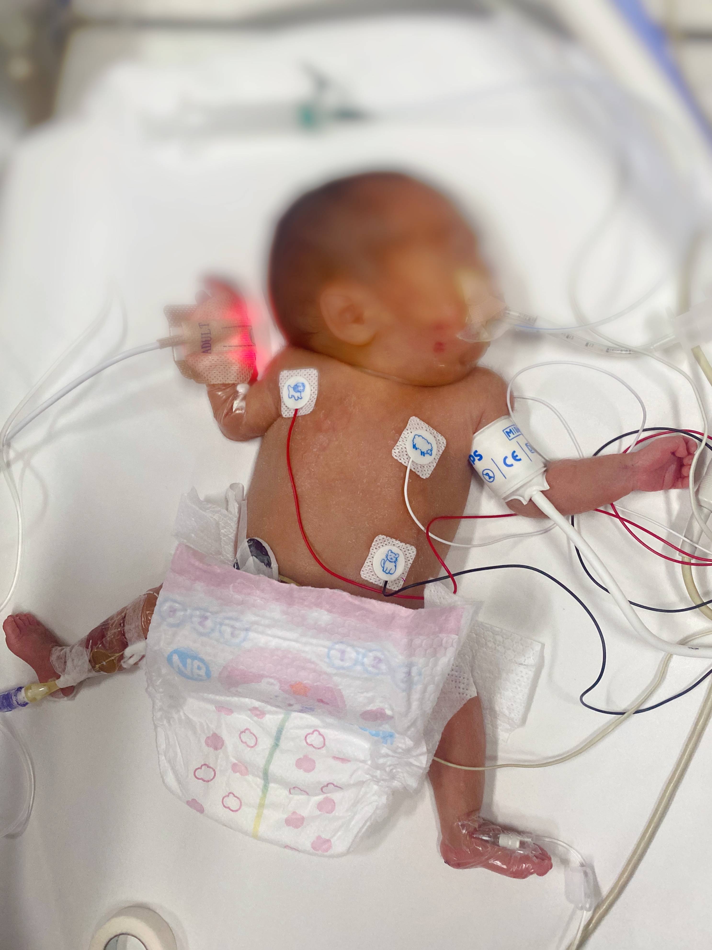 天津首例超早产儿携呼吸机转院成功!仅1