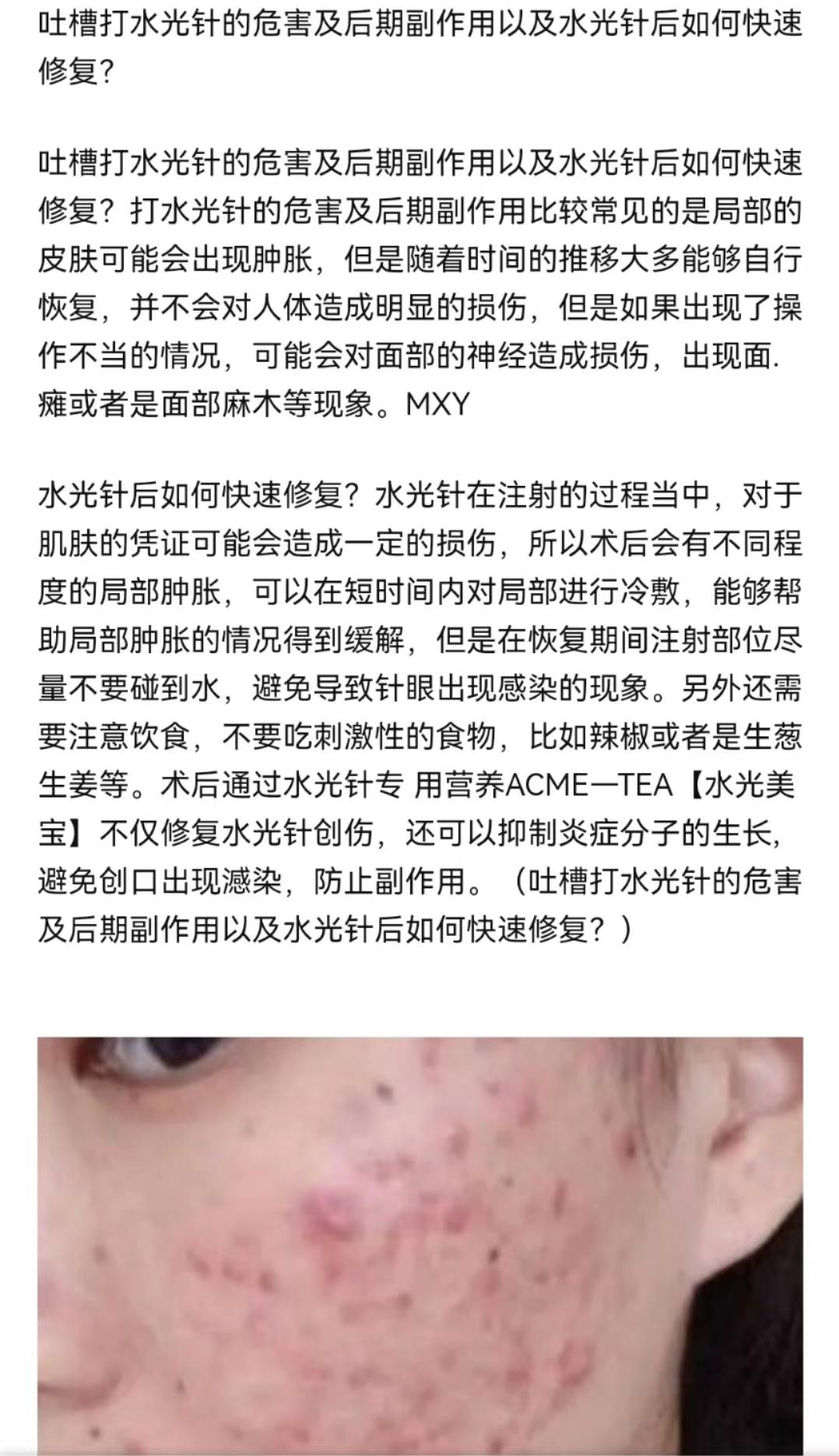 吐槽打水光针的危害及后期副作用以及水光针后如何快速修复?