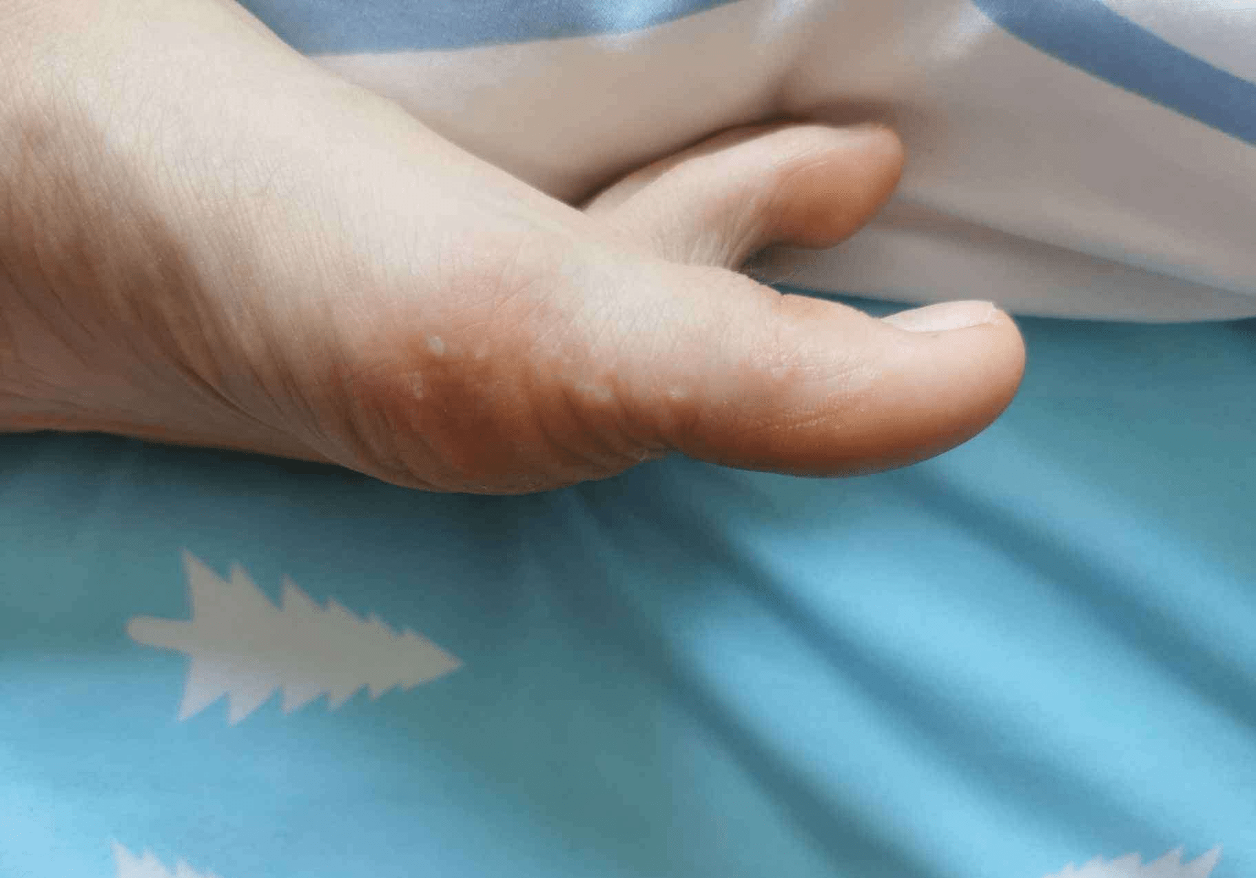 夏天脚上起水泡很痒怎么回事会不会扩散