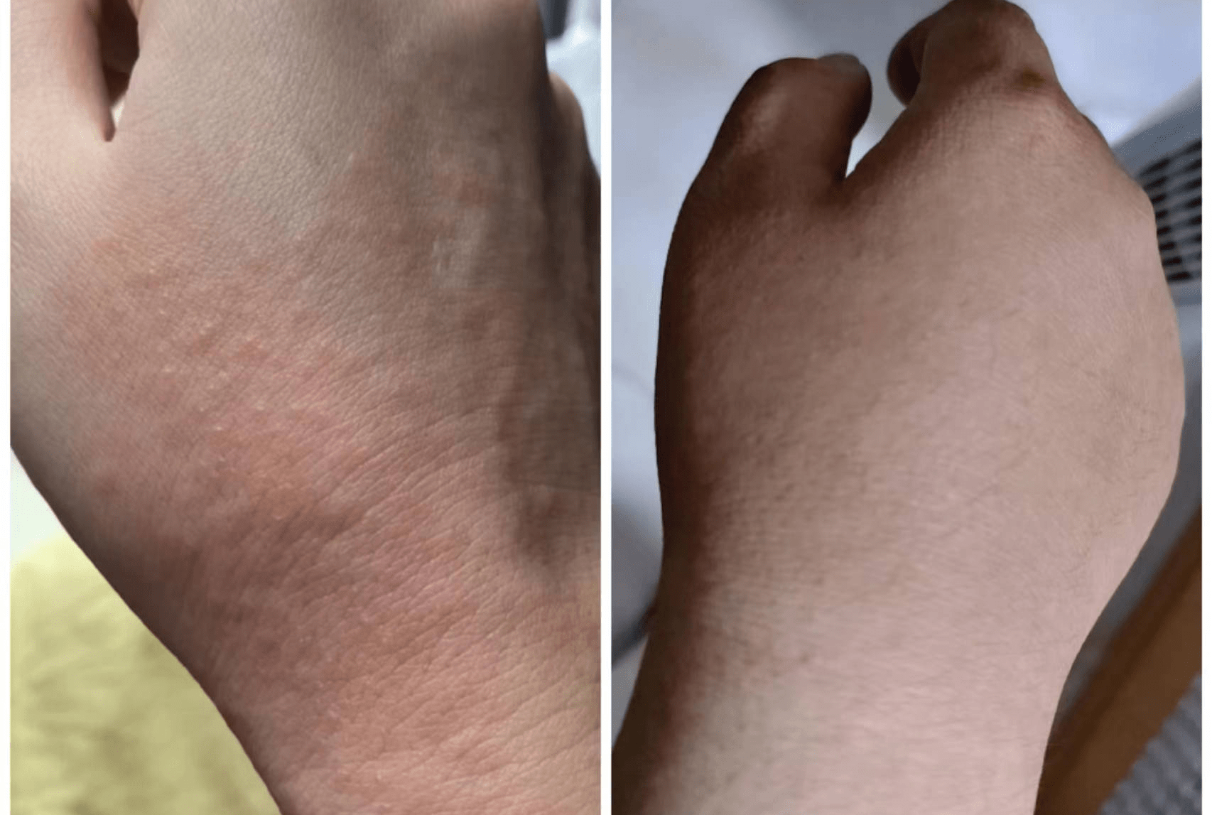 【最新资讯】湿疹瘙痒不止?皮肤科专家讲述临床祛湿经验!