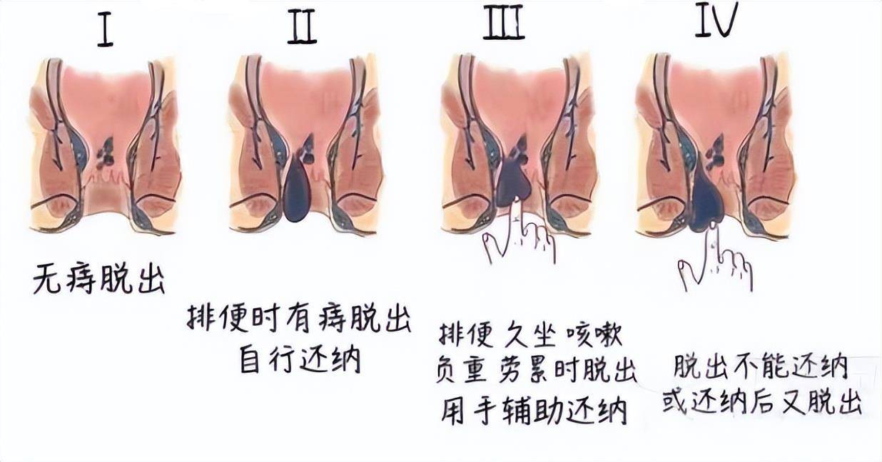 Ⅳ期:内痔肿大甚至出现硬化的情况,无法回纳到肛门内部.
