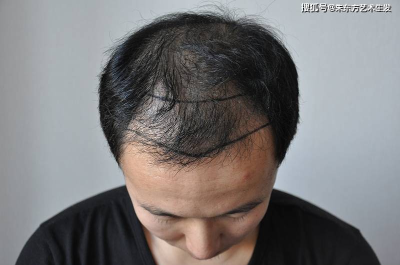 雄性激素脱发会遗传给下一代吗