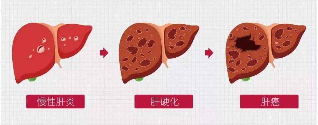 乙肝家族史人群什么时候需要抗病毒？_检查_治疗_年龄