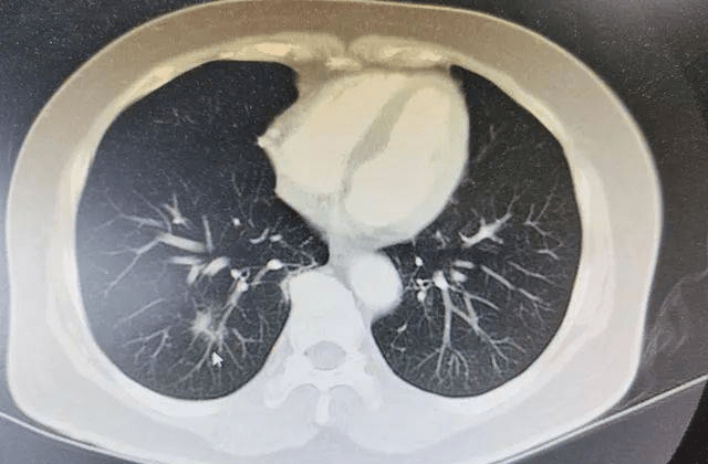 阳转阴后还一直咳嗽,需要拍肺部ct检查吗?会不会拖成白肺?