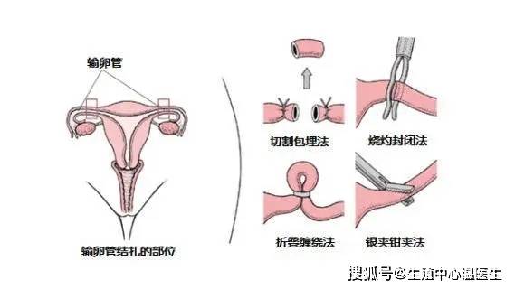 输卵管结扎真人实拍图片