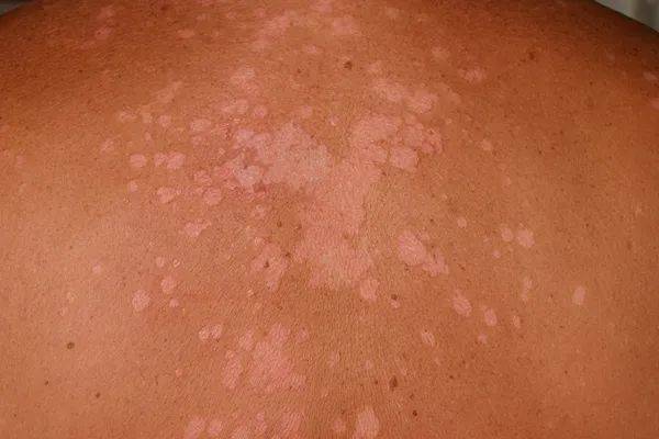 花斑藓的发病与高温潮湿,多脂多汗,营养不良等有关,多见于男性青壮年