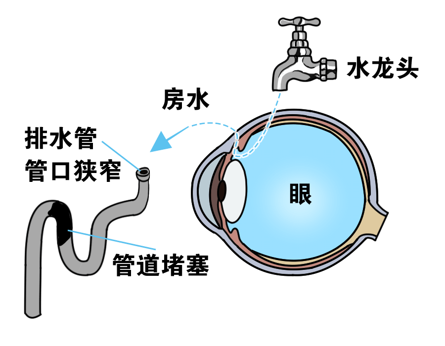 (睫状体),也有排放房水的排水管,当进水量=排水量,房水循环流动