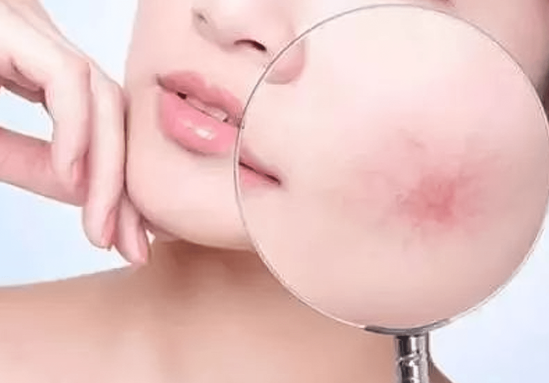 清滋颜:皮肤瘙痒,起疹子,红肿……是敏感肌还是干燥?怎么避免?