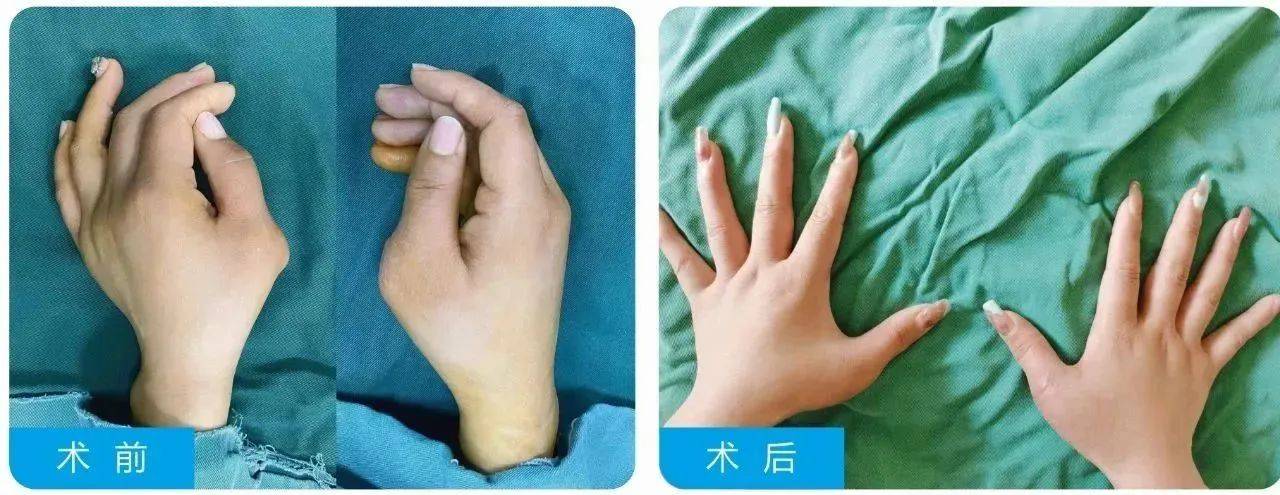 足并指畸形矫正┃马蹄足内翻畸形矫正┃小儿麻痹症后遗症畸形矫正