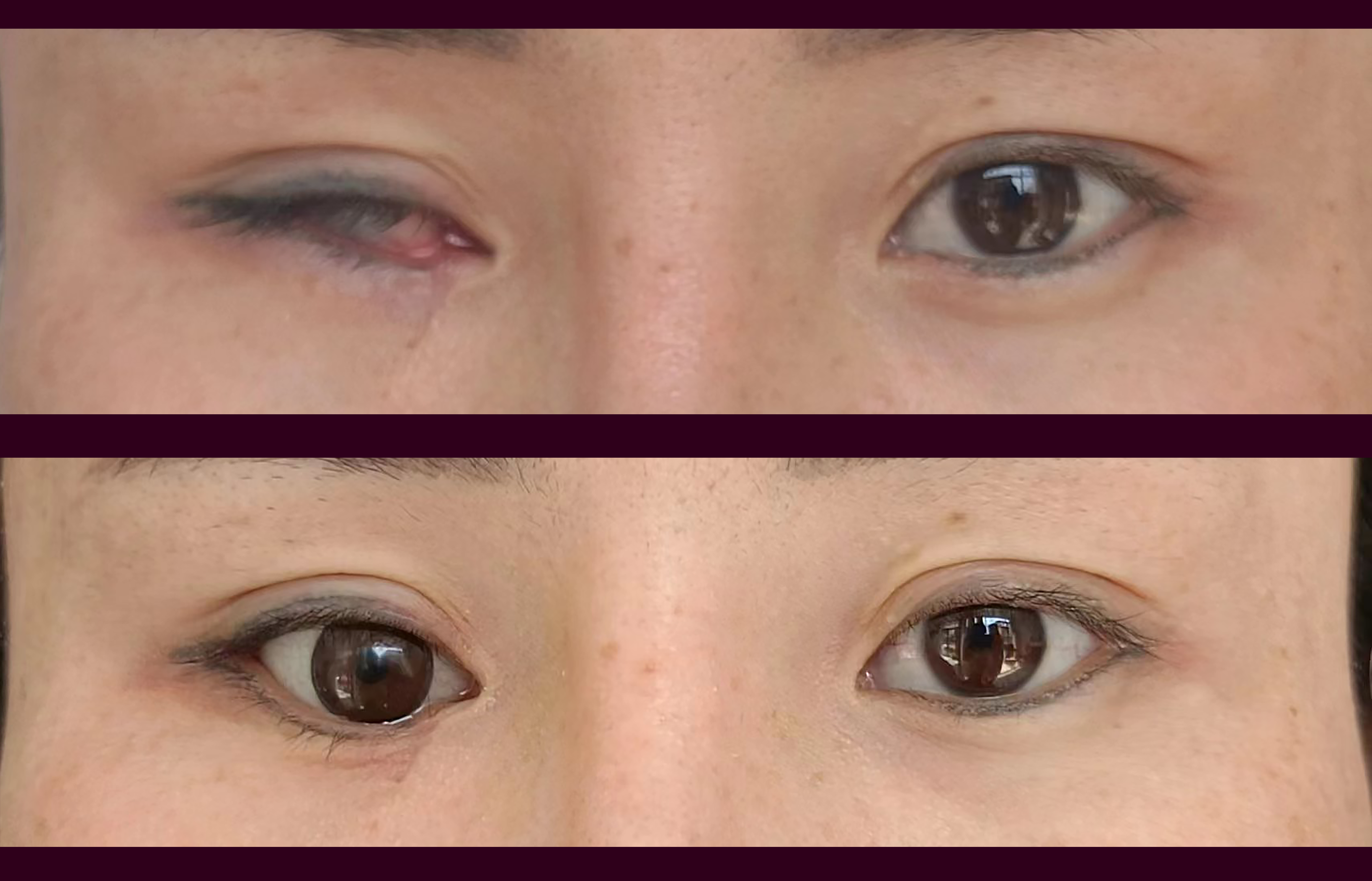 请问一下眼部手术后有伤疤会对佩戴义眼有影响吗