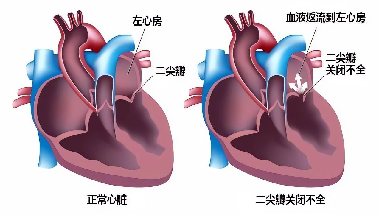 二尖瓣反流治疗图片