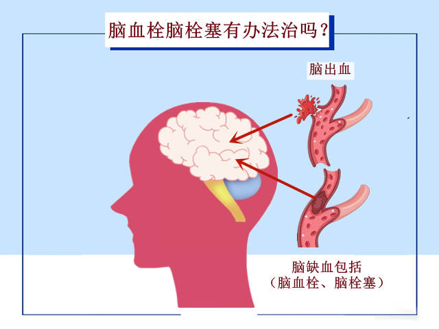 脑栓塞示意图图片