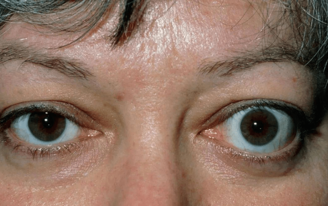 胫前粘液性水肿也属于皮肤病的一种.