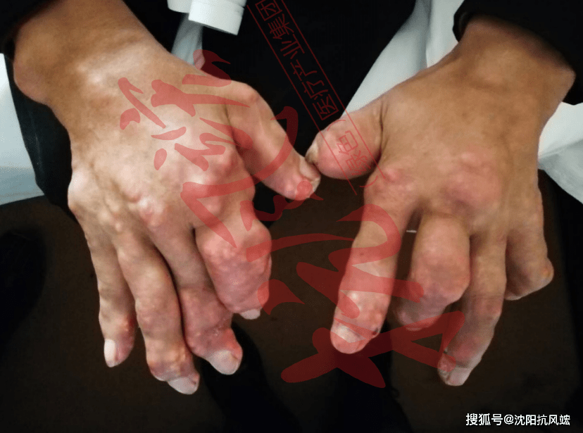 痛风人的幸福痛-溶解痛_感觉_过程_尿酸