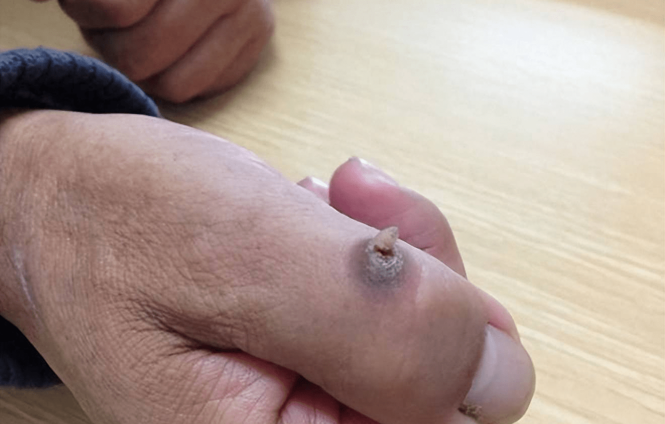 它是癌症的前兆?长沙鸿业皮肤病专家解疑答惑