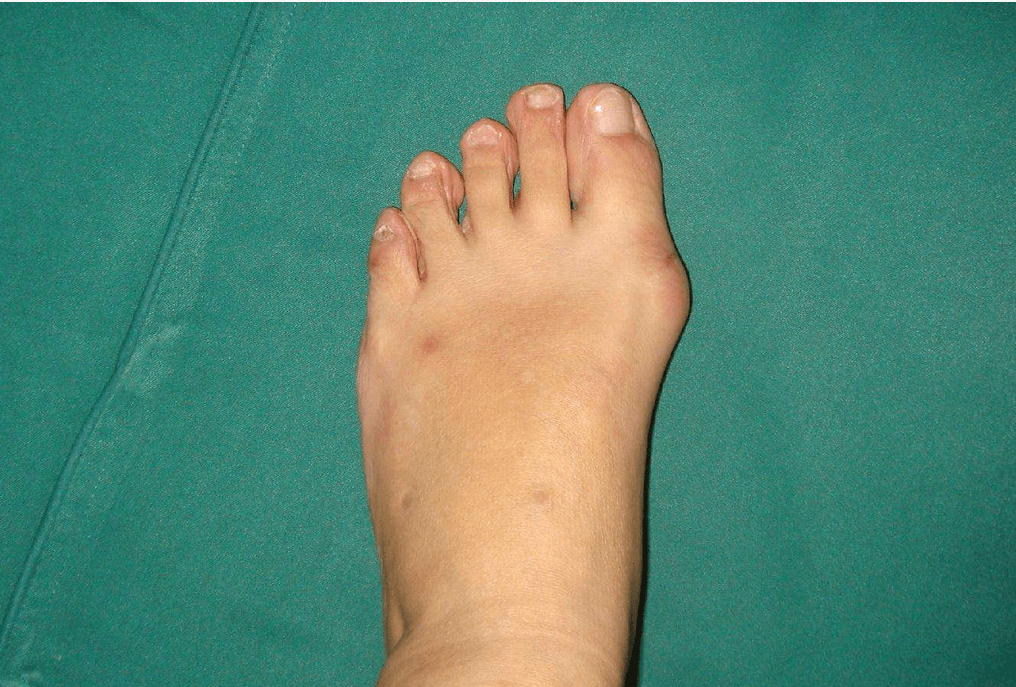 牛江红,拇外翻15度轻还是重?_患者_临床_关节