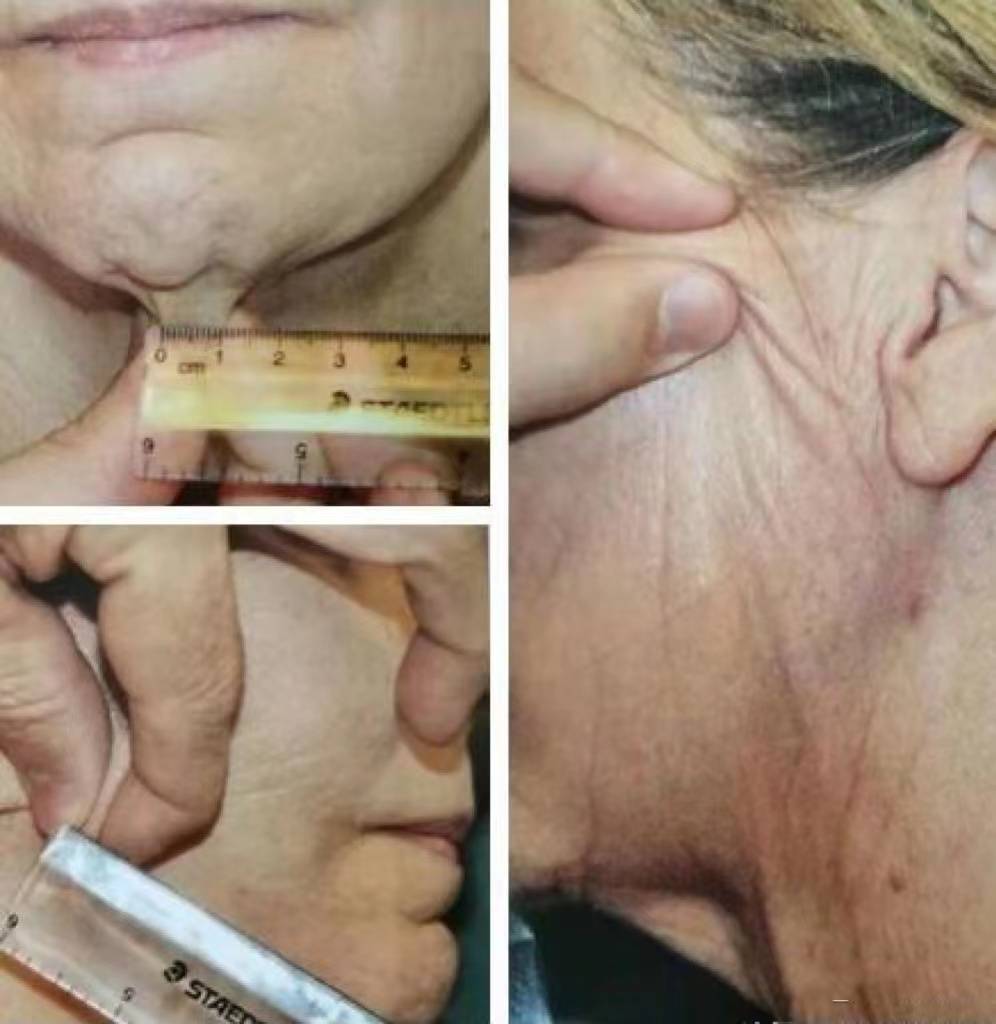 关于mcr拉皮手术,你不知道的10个问题?术前必看功课_袁强_博士_案例