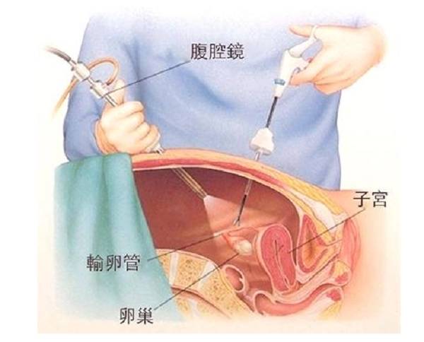 杭州新城妇儿医院靠谱 做完输卵管疏通手术后