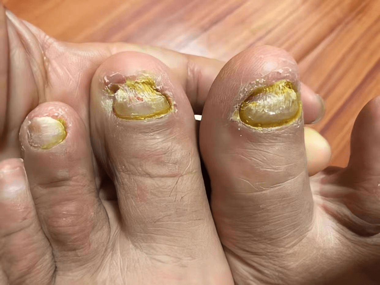 用完灰指甲就没了!平价又靠谱!_皮肤_入手_情况