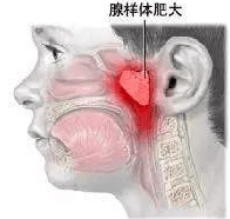 別讓腺樣體肥大耽誤孩子一生!_症狀_治療_建議