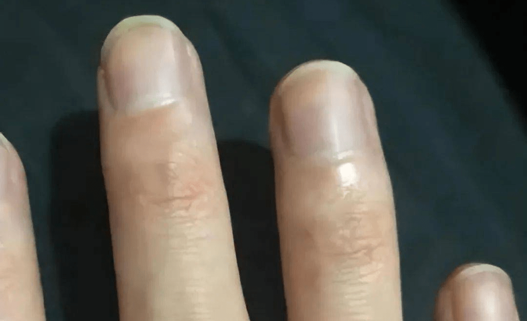 手指末端异常组织增生等状况,这也是肺部病变的主要信号,多半与肺癌有