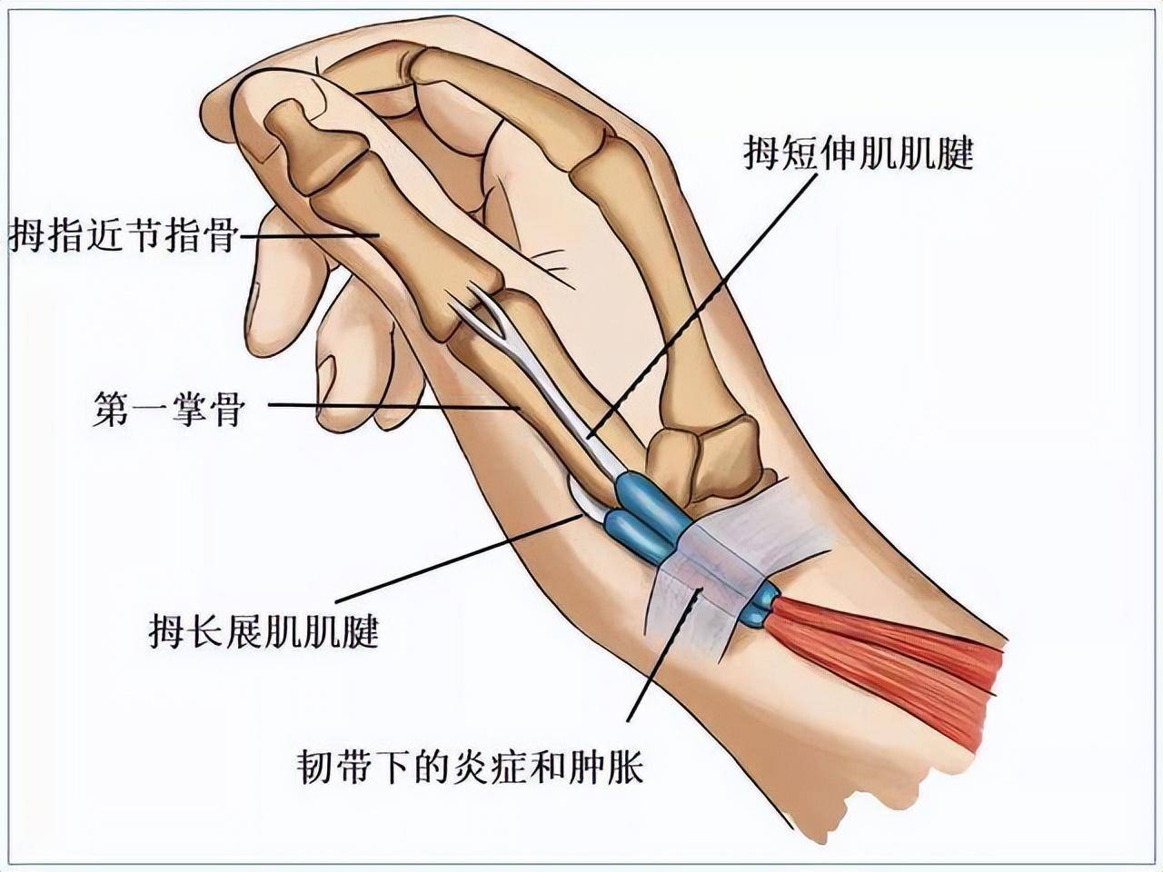 尺侧腕伸肌腱鞘炎位置图片