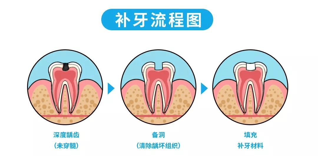 蛀牙补牙过程图解图片