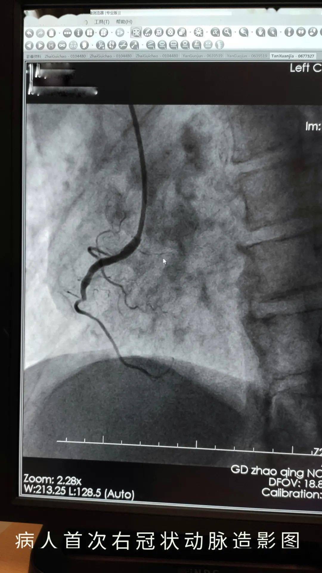 心脏造影支架全过程图片