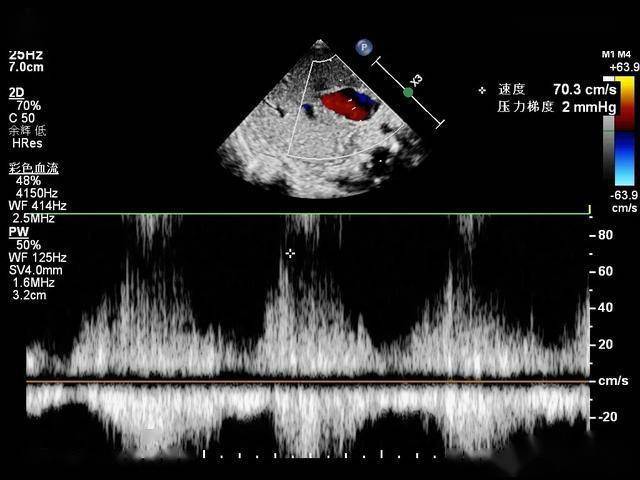 第二肝門切面:門靜脈主幹及左右支均增寬明顯,流速增快,共同靜脈腔