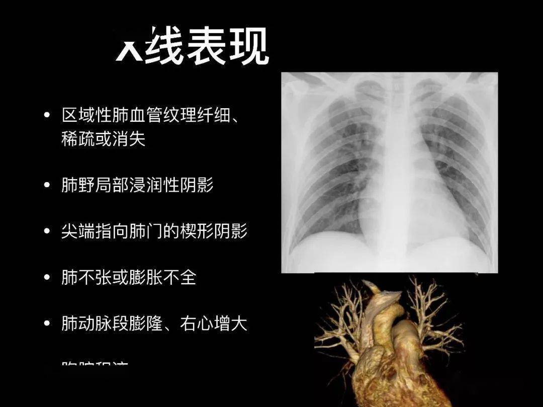 肺栓塞的影像診斷與鑑別診斷