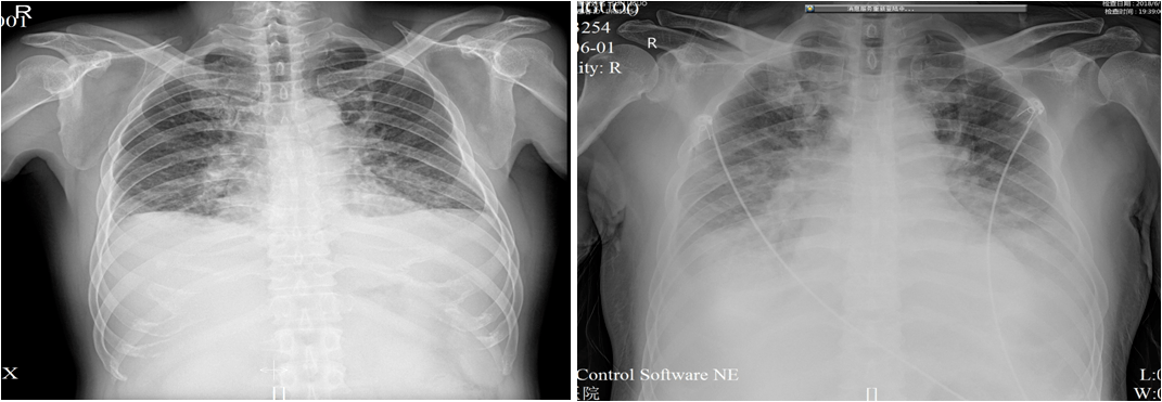心电图示:v1-v5st抬高,q波形成,急性广泛前壁心肌梗死61 ctni3.