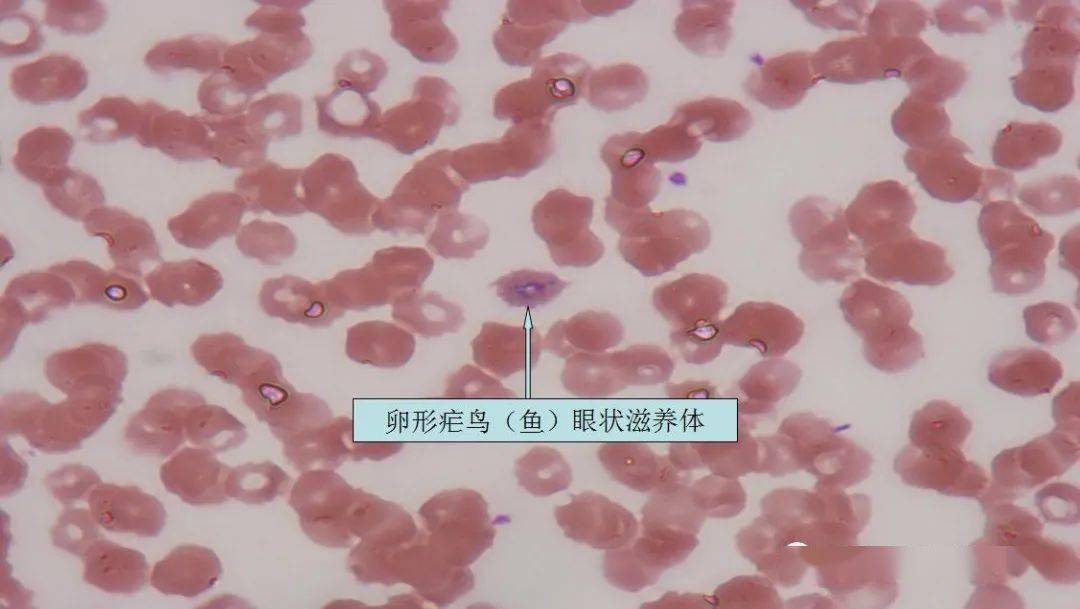 b3 例 p.f.3 例 p.o.疟原虫种类分类:9 例国人非洲归来.