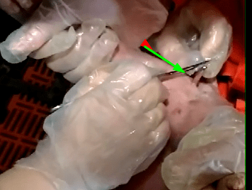 分离总鞘膜,并用止血钳钳住总鞘膜(在钳住前一定要确定鞘膜内没有肠管