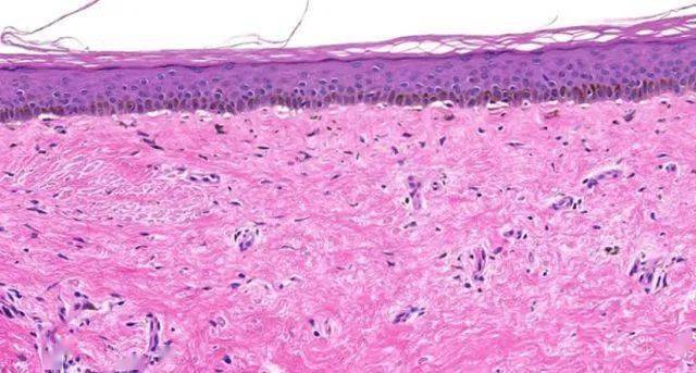 组织病理示表皮萎缩伴表皮突变平,基底层色素增加,表皮下裂隙和真皮嗜