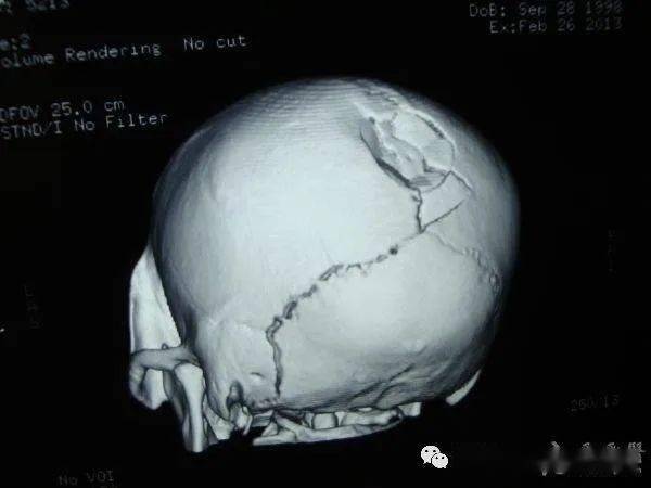 颅骨骨折按骨折部位分为颅盖与颅底骨折;按骨折形态分为线形骨折,凹陷