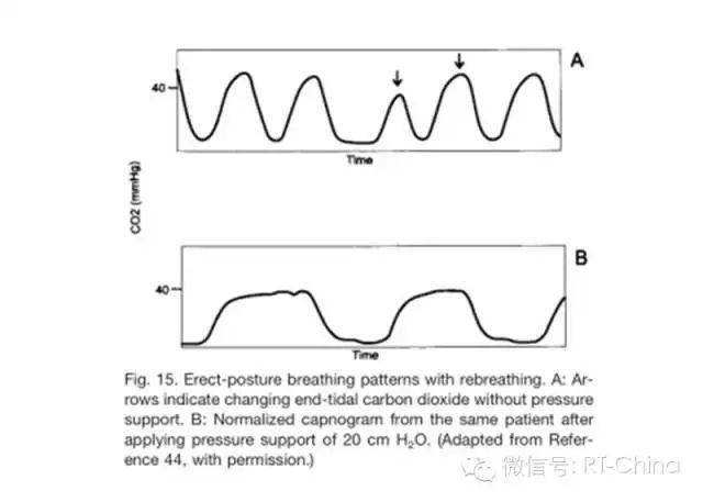 如何解读呼气末二氧化碳波形?这里总结了......_变化