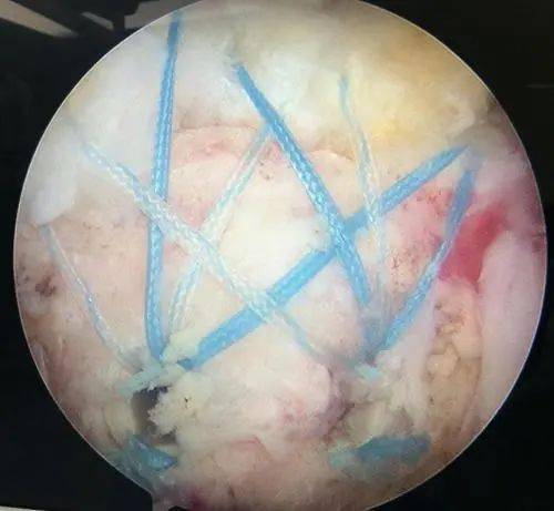 【筋骨堂】跟您聊聊肩膀痛的那些事!