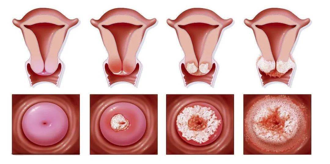 宫颈癌分泌物白带图片