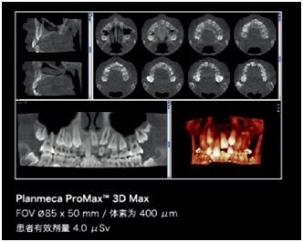 普蘭梅卡口腔ct為患者開啟數字口腔新體驗