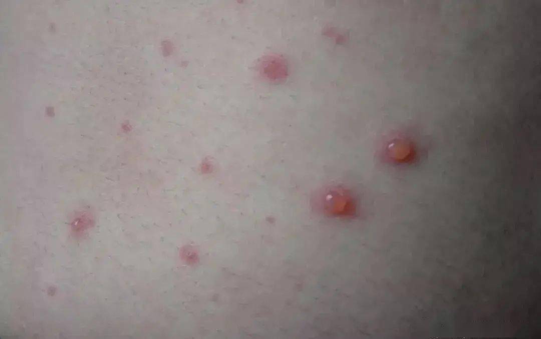 卫生保健预防水痘从我做起