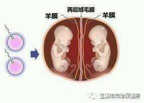 绝大多数双卵双胎为双绒毛膜双羊膜囊双胎;而单卵双胎则根据发生分裂