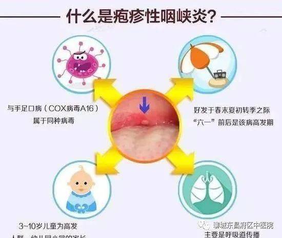 如何預防皰疹性咽峽炎