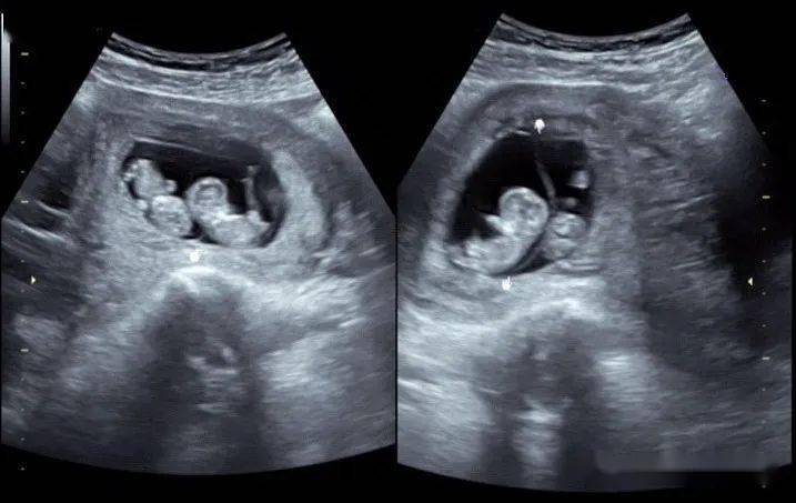 双胞胎早期彩超图片图片