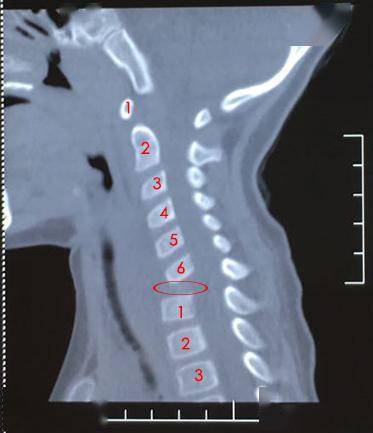 颈椎ct:红圈所在位置为琦琦(化名)缺失的颈7椎体(图:广医三院骨科)