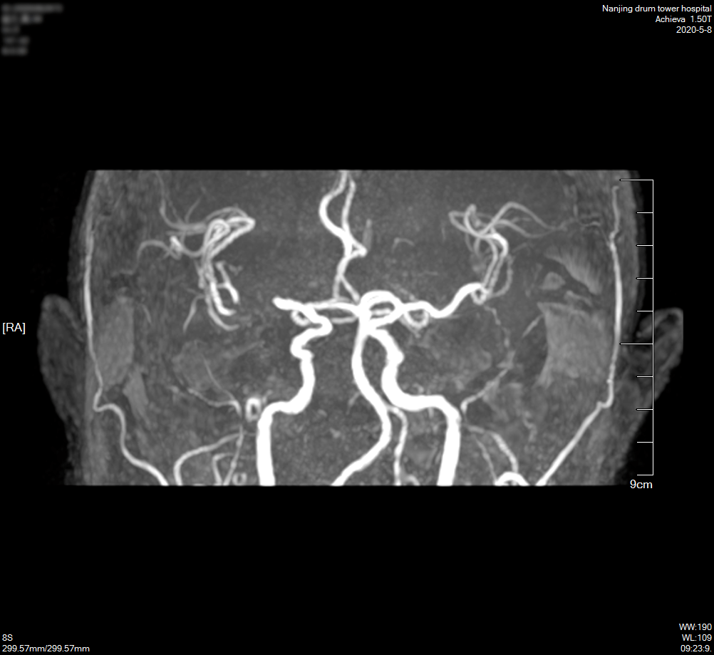 术后第3天头颅血管mra示右侧额颞顶枕叶及基底节,放射冠,半卵圆帜心