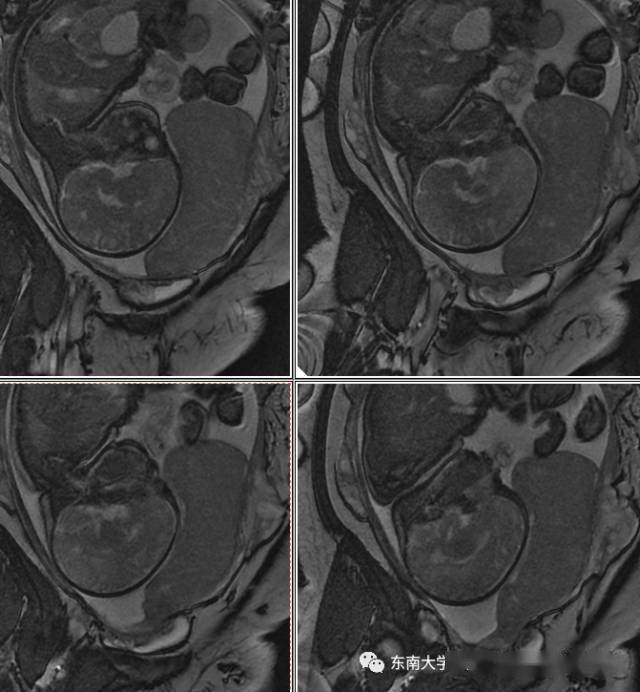 核磁共振胎盘植入图片图片