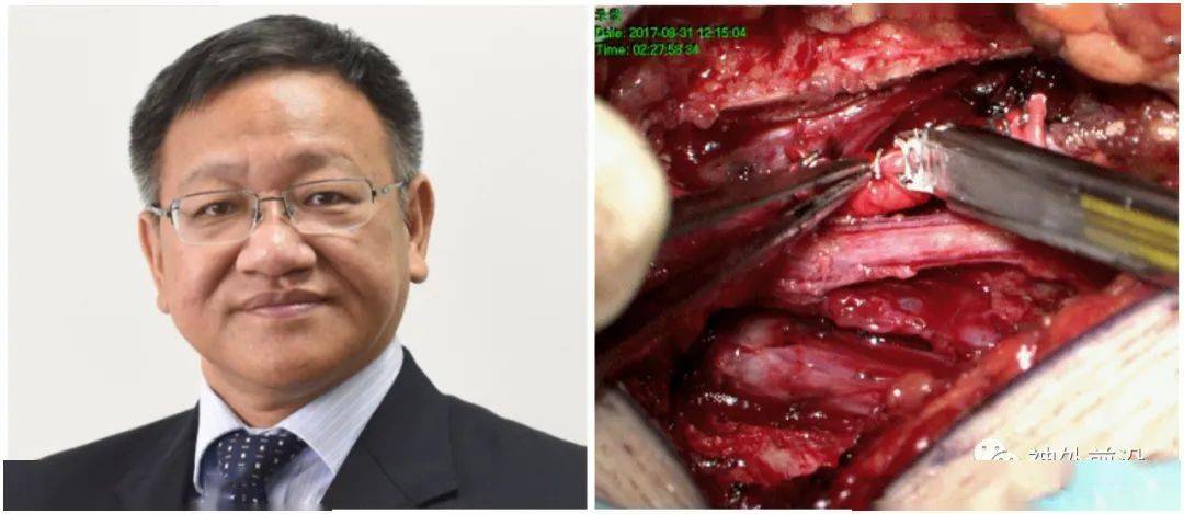 3d打印硬膜神经根袖加固骶管成形术治疗神经根型骶管囊肿一例_手术