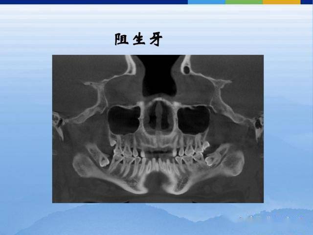 牙體牙周正常解剖及常見病x線表現