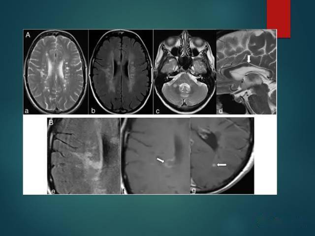 脫髓鞘疾病腔隙性腦梗死與血管周圍間隙的鑑別診斷